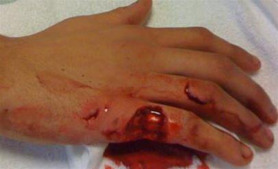 Førstehjælp og brandkursus, SAMN - UDSAT